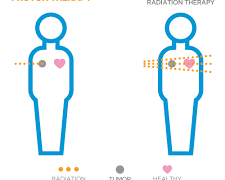 Radiation Therapy and Other Cancer Treatments