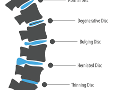 Will Physical Therapy Help A Herniated Disc?