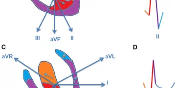 What Causes a Slightly Abnormal EKG?