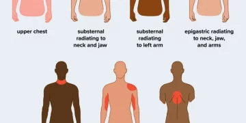 Early Heart Attack Symptoms in Females and Prevention