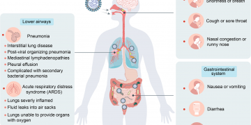 Why Does COVID-19 Cause Diarrhea for Some Sufferers?