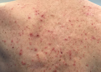 Is Itchy Skin a COVID Symptom?
