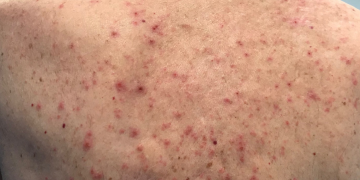 Is Itchy Skin a COVID Symptom?