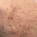 Is Itchy Skin a COVID Symptom?